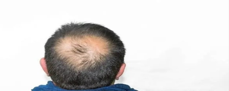 秃顶了有什么办法补救 秃顶会遗传给下一代吗